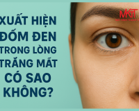 XUẤT HIỆN ĐỐM ĐEN TRONG LỒNG TRẮNG MẮT CÓ SAO KHÔNG?